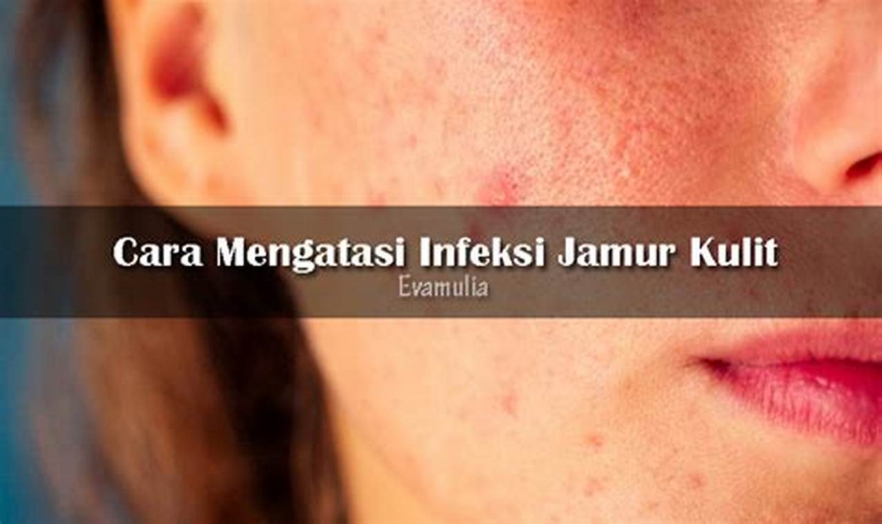 Cara Mengatasi Jamur Kulit Cara Mengatasi Jamur Kulit